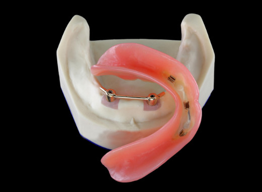 Implant dentaire de sécurité de laboratoire de haut dentier inter biologique de miscibilité