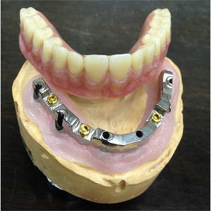Implant dentaire de sécurité de laboratoire de haut dentier inter biologique de miscibilité