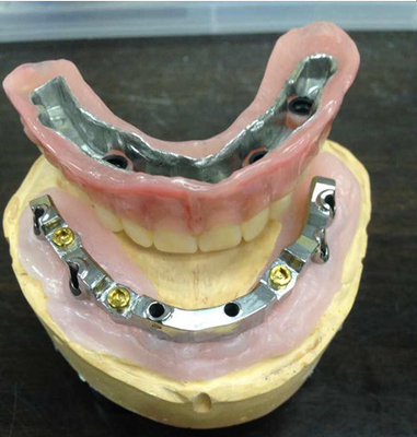Implant dentaire de sécurité de laboratoire de haut dentier inter biologique de miscibilité