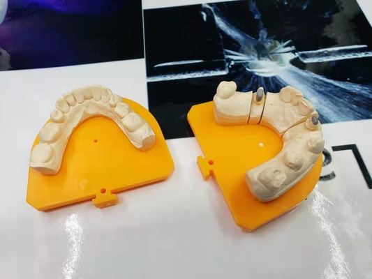 Couronne en céramique dentaire de la couronne PFM de porcelaine de haute résistance d'or jaune