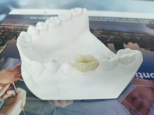 Onlay dentaire Tout-en céramique durable de marqueterie de placage de couronne de FDA semblable