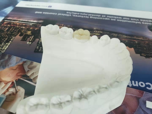 Onlay dentaire Tout-en céramique durable de marqueterie de placage de couronne de FDA semblable