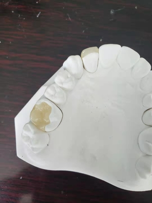 Onlay dentaire Tout-en céramique durable de marqueterie de placage de couronne de FDA semblable