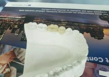 Couronne flexible durable IPS dentaire E Max Press Inlay Onlay de pont de PFM