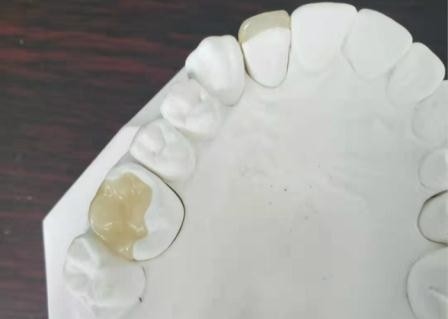 Couronne flexible durable IPS dentaire E Max Press Inlay Onlay de pont de PFM