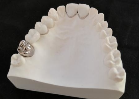 Résistance à la corrosion adaptée aux besoins du client en métal dentaire de couronne de porcelaine de PFM plein