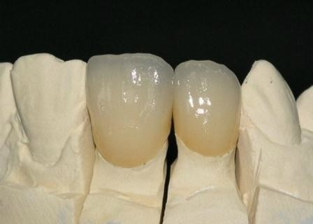 Couronne de métal céramique extérieure lisse de PFM anticorrosion