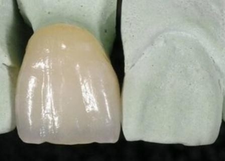 Couronne de métal céramique extérieure lisse de PFM anticorrosion