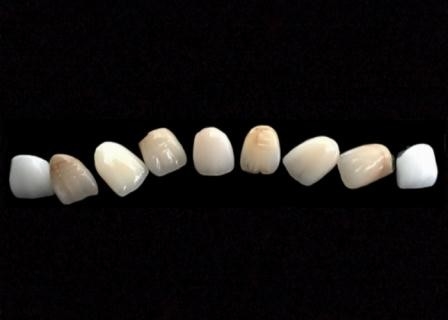Couronne de métal céramique extérieure lisse de PFM anticorrosion