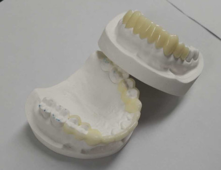 Haute durabilité DAO CAM impression 3D temporaire couronne la résine durable
