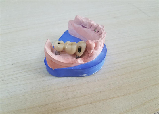Couronne dentaire de zircone du DAO FAO avec la butée basse titanique de zircone