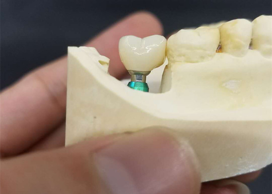 Couleur ultra dur l'OEM de stabilité la couronne d'implant que dentaire facile maintiennent