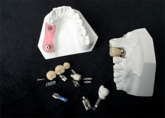 Haute couronne d'implant dentaire de zircone de longévité pour la restauration dentaire