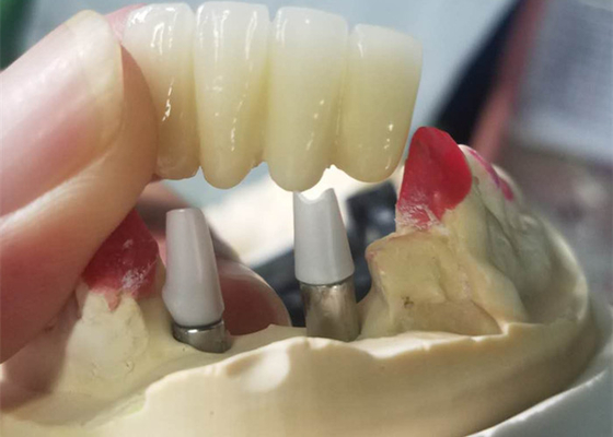 Base forte de Ti fraisant le pont soutenu par dent de couronnes d'implant dentaire