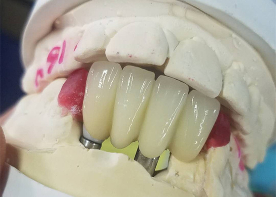 Base forte de Ti fraisant le pont soutenu par dent de couronnes d'implant dentaire