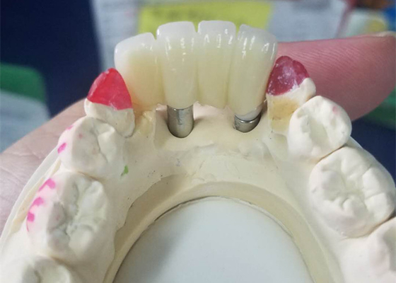 Base forte de Ti fraisant le pont soutenu par dent de couronnes d'implant dentaire