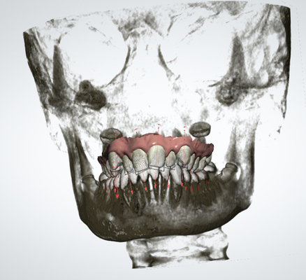 Extenseur palatal rapide d'OEM d'appareils orthodontiques démontables précis