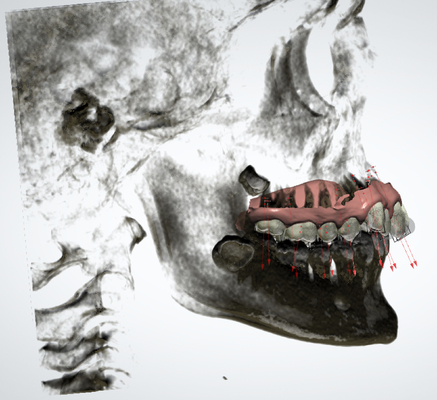 Les appareils orthodontiques fixes en caoutchouc adaptés aux besoins du client faciles maintiennent