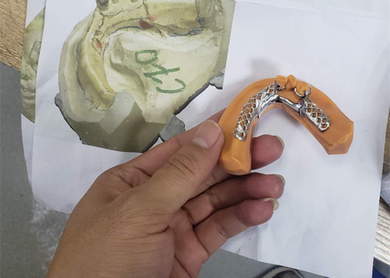 Le pont dentaire flexible en couronne de Digital PFM ultra dur facile maintiennent