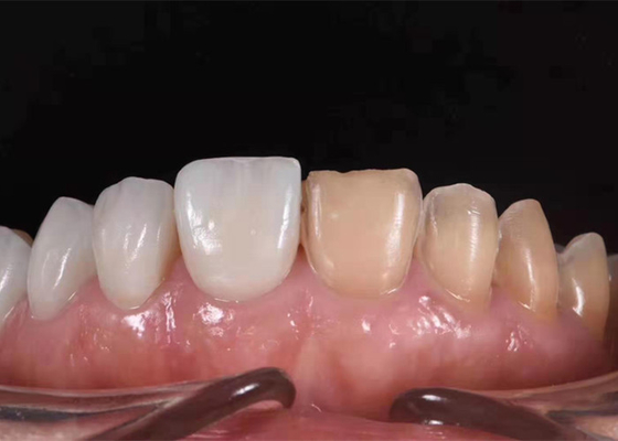 Couronne dentaire en céramique de blanchiment de 0.3MM pour remplacer les dents malsaines