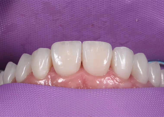 Couronne dentaire en céramique de blanchiment de 0.3MM pour remplacer les dents malsaines