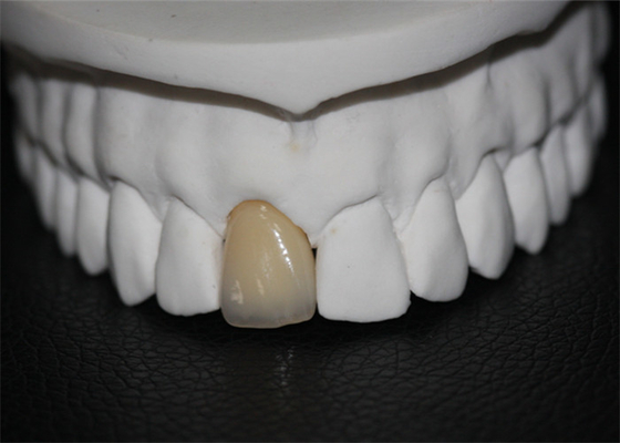 Couronne dentaire de porcelaine de Cr de Co