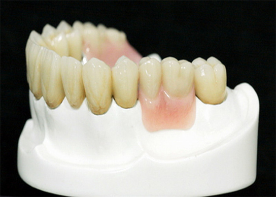 Prothèse de fixation de précision MK1 pour un ajustement et une protection parfaits