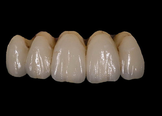 Facile maintenez la stabilité de la couleur dentaire de couronne de porcelaine orthodontique de PFM