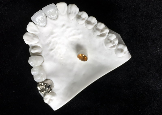Matériel biologique de Technologie de pointe de bonne de Biocompatibility couronne dentaire de porcelaine