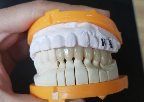 Couronnes en céramique faites sur commande de la taille PFM pour les dents postérieures et antérieures