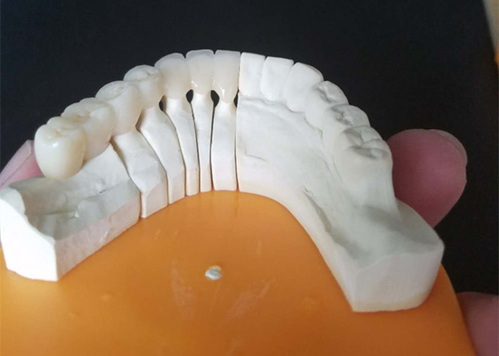 Couronnes en céramique faites sur commande de la taille PFM pour les dents postérieures et antérieures