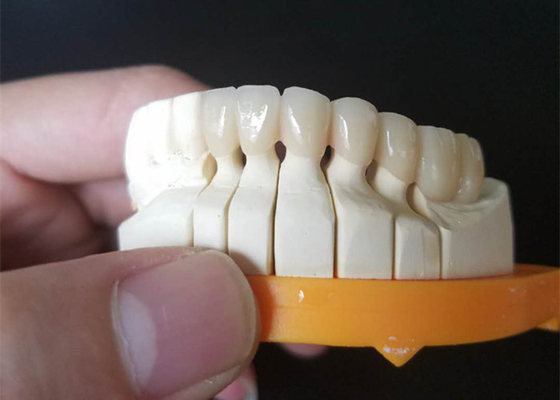 Couronnes en céramique faites sur commande de la taille PFM pour les dents postérieures et antérieures