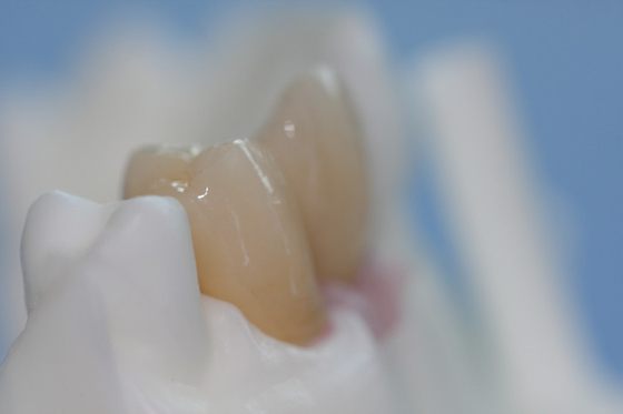Butée faite sur commande de titane de barre pure démontable d'implant dentaire