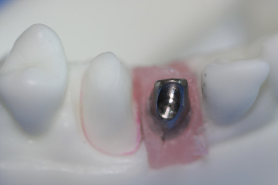 Butée faite sur commande de titane de barre pure démontable d'implant dentaire