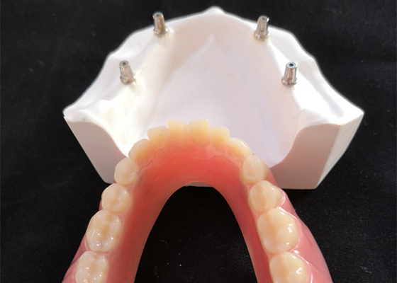 L'implant dentaire confortable Overdenture du DAO FAO facile maintiennent