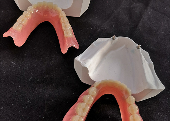 L'implant dentaire confortable Overdenture du DAO FAO facile maintiennent