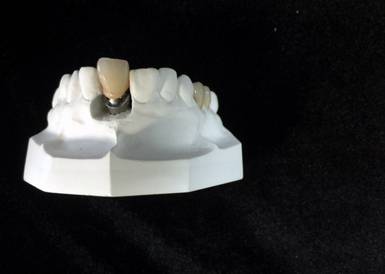 Dentier de forte stabilité d'attachement de barre de repères faits sur commande d'implant dentaire