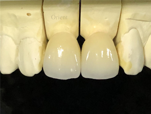 Couronnes dentaires en céramique, couronnes dentaires en zirconium