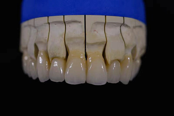 Laboratoire de fabrication de prothèses obtenant des prothèses parfaitement blanches avec la réparation en zirconium