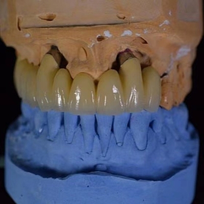 La porcelaine de couronne de FDA PFM a fondu à la couronne en métal