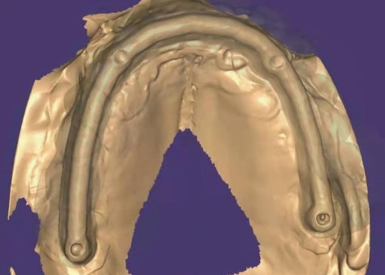 Couronne dentaire en zirconium: dents d'aspect naturel, durables et sûres