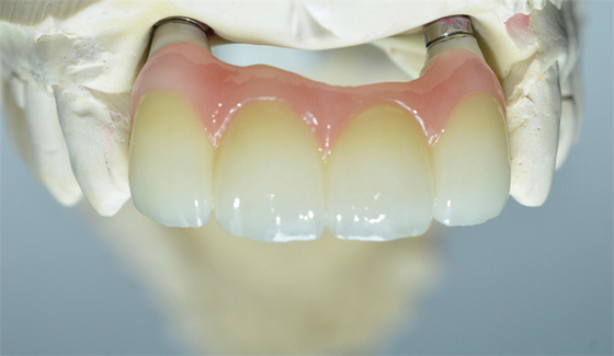 Base forte de Ti fraisant le pont soutenu par dent de couronnes d'implant dentaire
