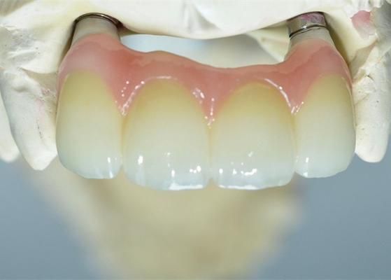 Base forte de Ti fraisant le pont soutenu par dent de couronnes d'implant dentaire
