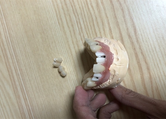 Couronne précise d'implant de dent d'attachements d'implant dentaire de Biocompatibility