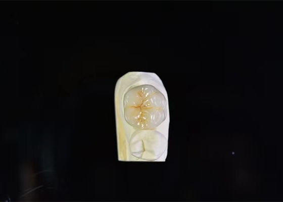 Super résistance couronne dentaire en porcelaine haute intermissibilité biologique