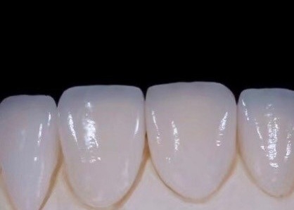 EMAX Durabilité Les facettes dentaires composites CAD/CAM très détaillées précises