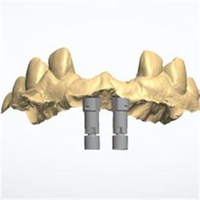 Une couronne en zirconium 3D personnalisée offrant une durabilité durable conçue pour répondre aux besoins des professionnels dentaires et des laboratoires