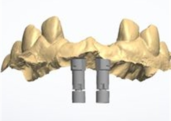 Conception CAD/CAM précise de couronne dentaire en zirconium pour l'ajustement