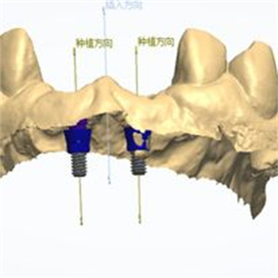 Conception CAD/CAM précise de couronne dentaire en zirconium pour l'ajustement