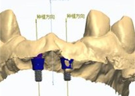 Modèle 3D Couronne de zirconium